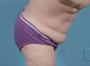 After Image: Midline Incisional Hernia Repair - right-side