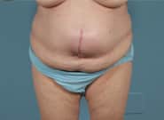 Before Image: Midline Incisional Hernia Repair - front