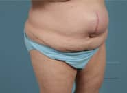 Before Image: Midline Incisional Hernia Repair - right-front-oblique