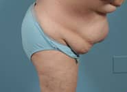 Before Image: Midline Incisional Hernia Repair - right-side
