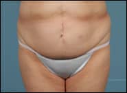 After Image: Midline Incisional Hernia Repair - front