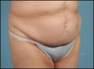 After Image: Midline Incisional Hernia Repair - right-front-oblique