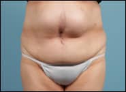 Before Image: Midline Incisional Hernia Repair - front