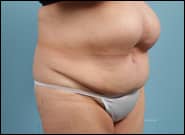 Before Image: Midline Incisional Hernia Repair - right-front-oblique