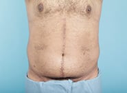 After Image: Midline Incisional Hernia Repair - front