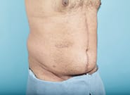 After Image: Midline Incisional Hernia Repair - right-front-oblique