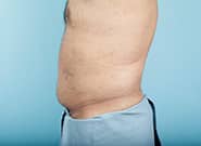 After Image: Midline Incisional Hernia Repair - left-side