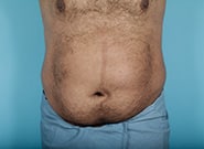Before Image: Midline Incisional Hernia Repair - front