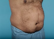 Before Image: Midline Incisional Hernia Repair - right-front-oblique