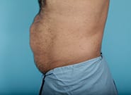 Before Image: Midline Incisional Hernia Repair - left-side