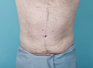 After Image: Midline Incisional Hernia Repair - front