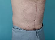 After Image: Midline Incisional Hernia Repair - right-front-oblique