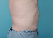 After Image: Midline Incisional Hernia Repair - right-side