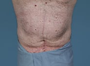 Before Image: Midline Incisional Hernia Repair - front