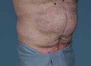 Before Image: Midline Incisional Hernia Repair - right-front-oblique