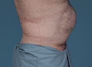 Before Image: Midline Incisional Hernia Repair - right-side