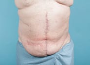After Image: Midline Incisional Hernia Repair - front