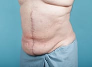 After Image: Midline Incisional Hernia Repair - left-front-oblique