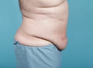 After Image: Midline Incisional Hernia Repair - right-side