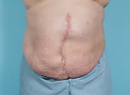 Before Image: Midline Incisional Hernia Repair - front