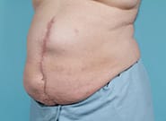 Before Image: Midline Incisional Hernia Repair - left-front-oblique