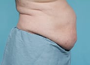 Before Image: Midline Incisional Hernia Repair - right-side