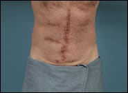 After Image: Midline Incisional Hernia Repair - front