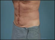 After Image: Midline Incisional Hernia Repair - left-front-oblique