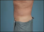 After Image: Midline Incisional Hernia Repair - left-side