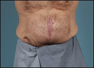Before Image: Midline Incisional Hernia Repair - front