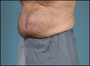 Before Image: Midline Incisional Hernia Repair - left-front-oblique