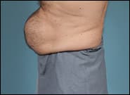 Before Image: Midline Incisional Hernia Repair - left-side