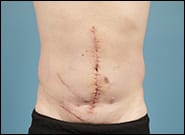 After Image: Midline Incisional Hernia - front