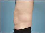After Image: Midline Incisional Hernia - left-side
