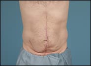 Before Image: Midline Incisional Hernia - front