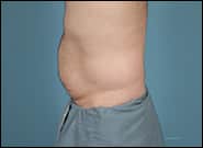 Before Image: Midline Incisional Hernia - left-side