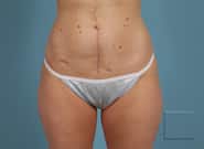 After Image: Midline Incisional Hernia - front