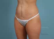 After Image: Midline Incisional Hernia - left-front-oblique