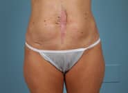 Before Image: Midline Incisional Hernia - front