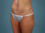 Before Image: Midline Incisional Hernia - left-front-oblique