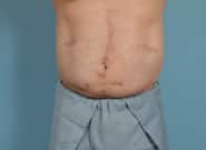 After Image: Midline Incisional Hernia Repair - front