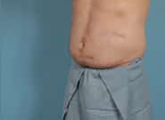 After Image: Midline Incisional Hernia Repair - left-front-oblique