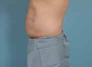 After Image: Midline Incisional Hernia Repair - left-side
