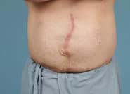 Before Image: Midline Incisional Hernia Repair - front
