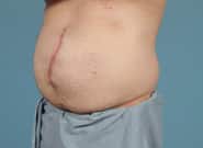 Before Image: Midline Incisional Hernia Repair - left-front-oblique