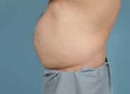 Before Image: Midline Incisional Hernia Repair - left-side