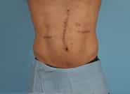 After Image: Midline Incisional Hernia Repair - front