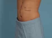 After Image: Midline Incisional Hernia Repair - left-front-oblique