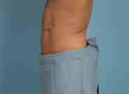 After Image: Midline Incisional Hernia Repair - left-side