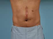 Before Image: Midline Incisional Hernia Repair - front